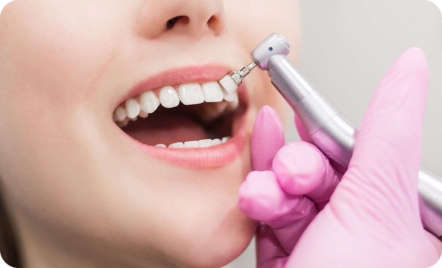 Dental Scaling & Polishing Treatment
