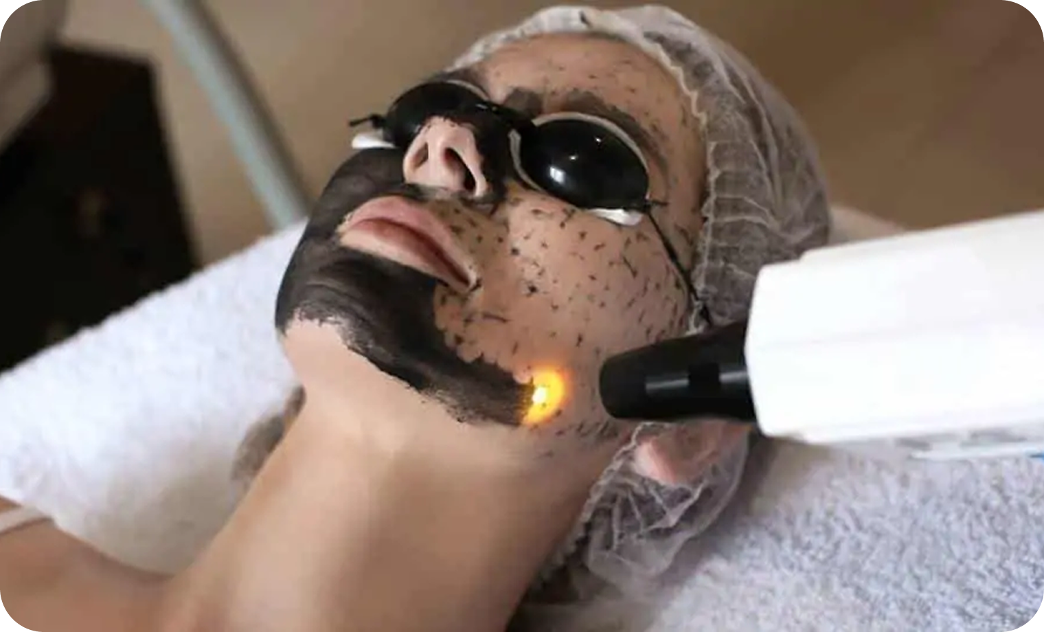 Hydra Facial + Carbon Laser Treatment In Lahore