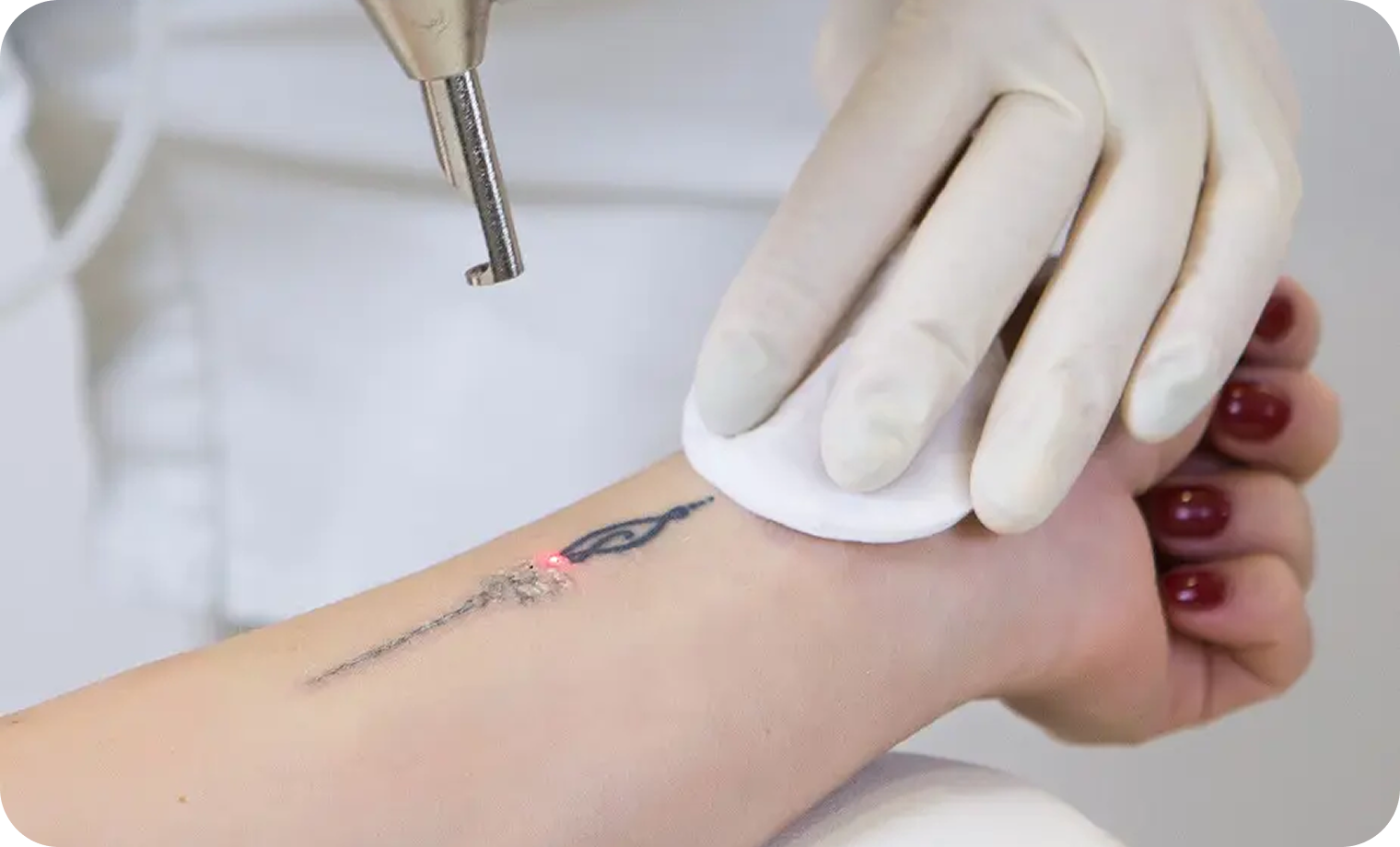 Laser Tattoo Removal In Lahore
