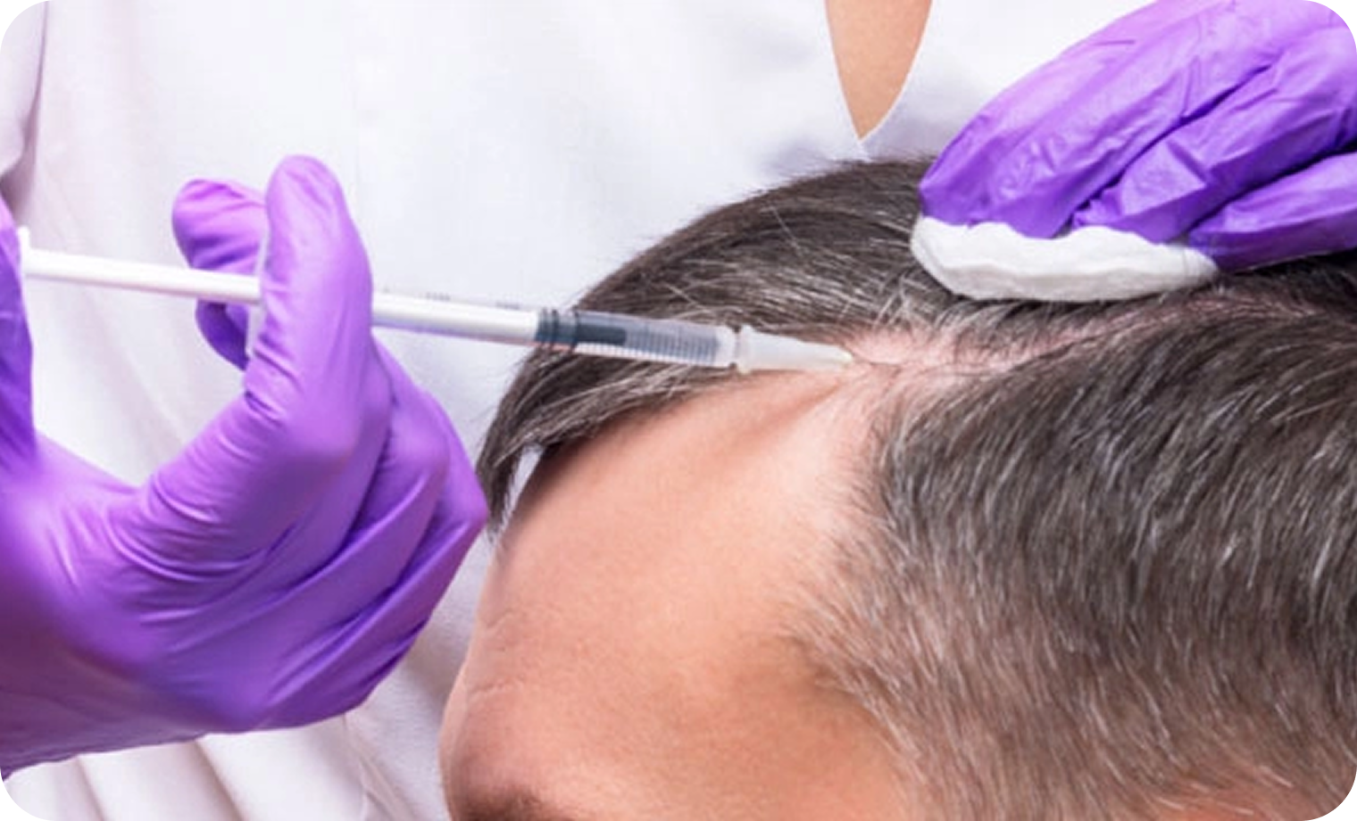 Hair PRP Treatment