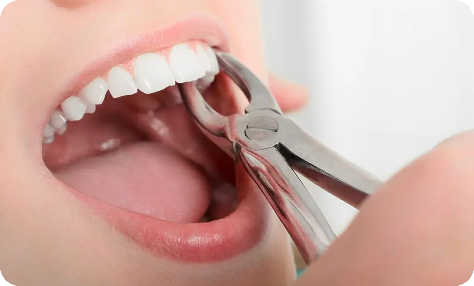 Simple Tooth Extraction In Lahore