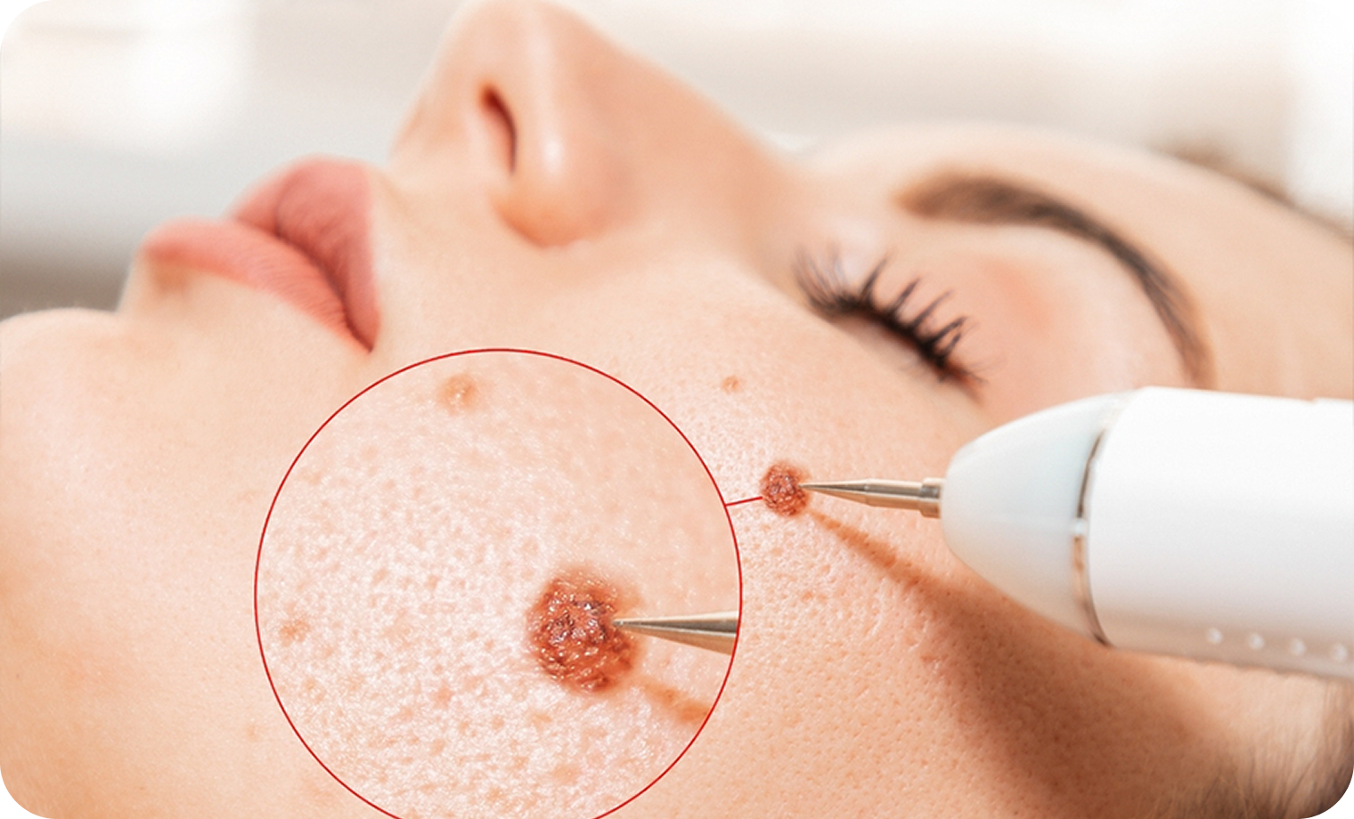 Warts Removal In Lahore