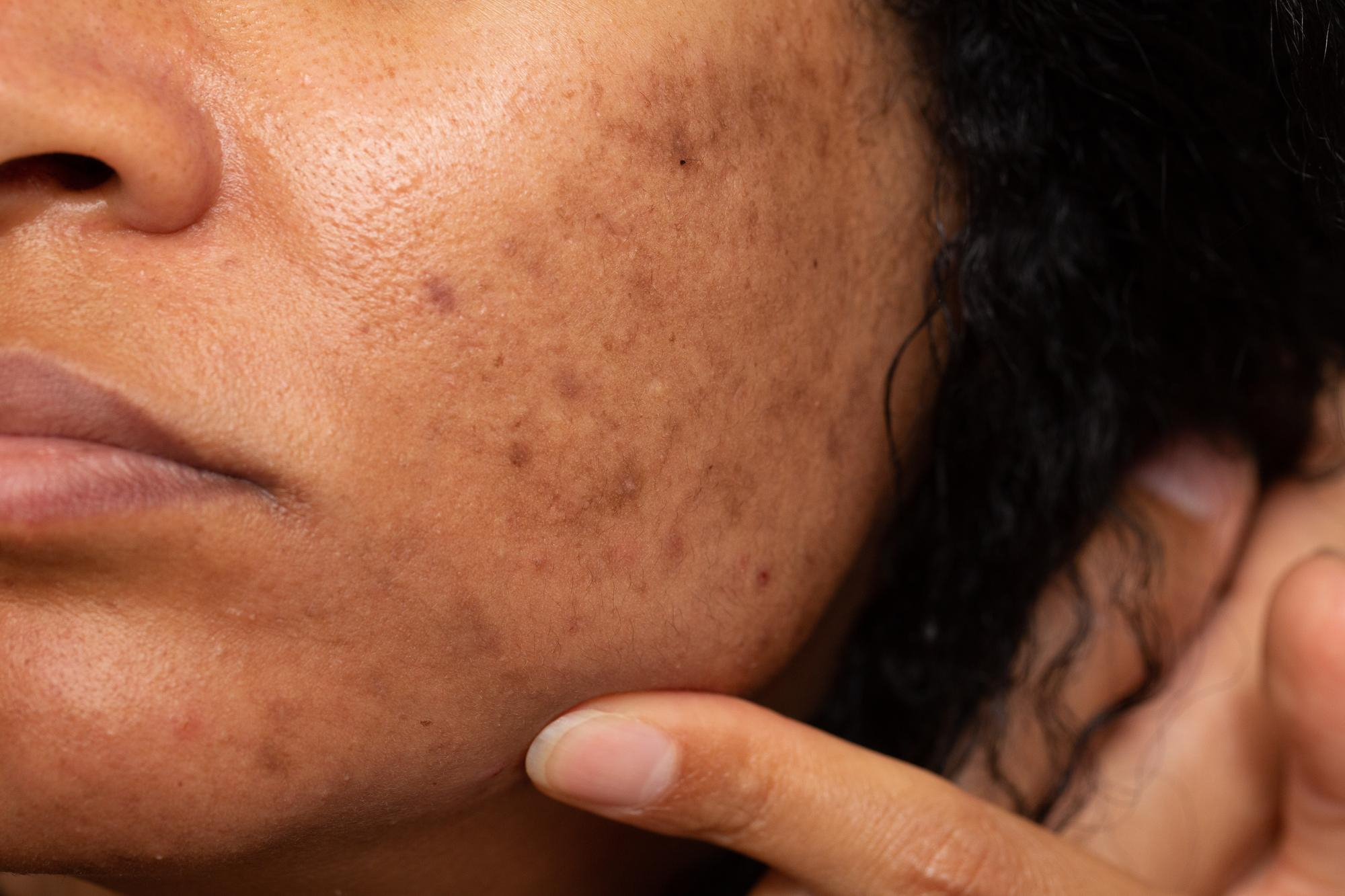 what-is-melasma