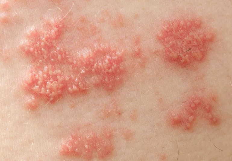 what-is-shingles