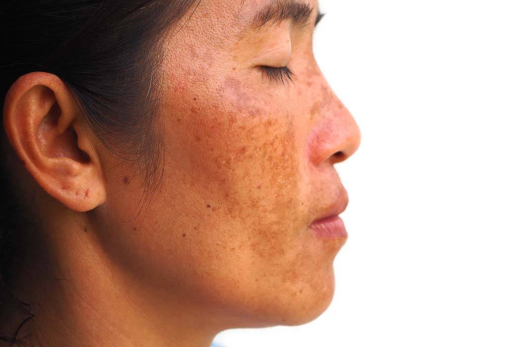 causes-of-melasma
