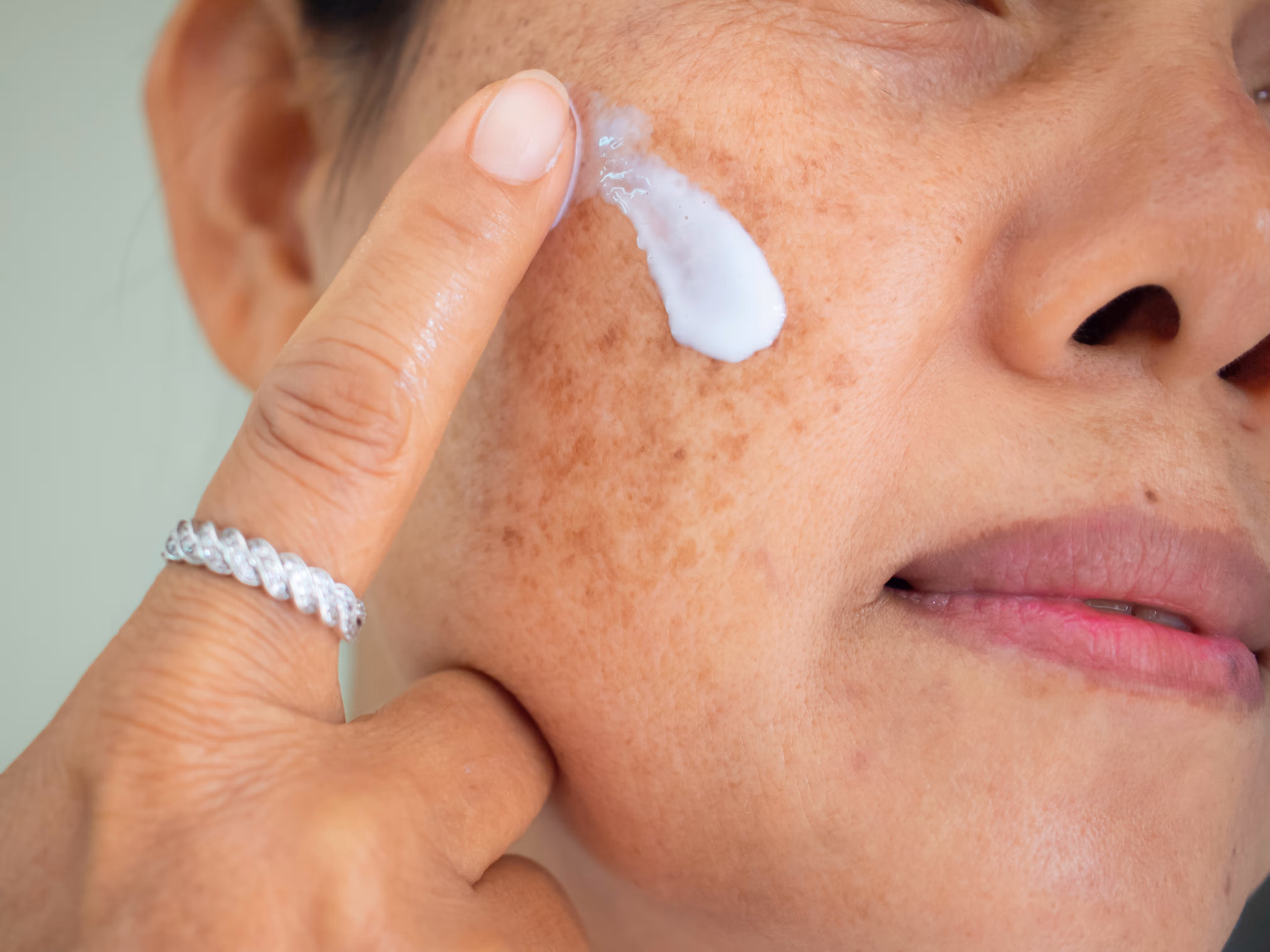 home-remedies-for-melasma-treatment