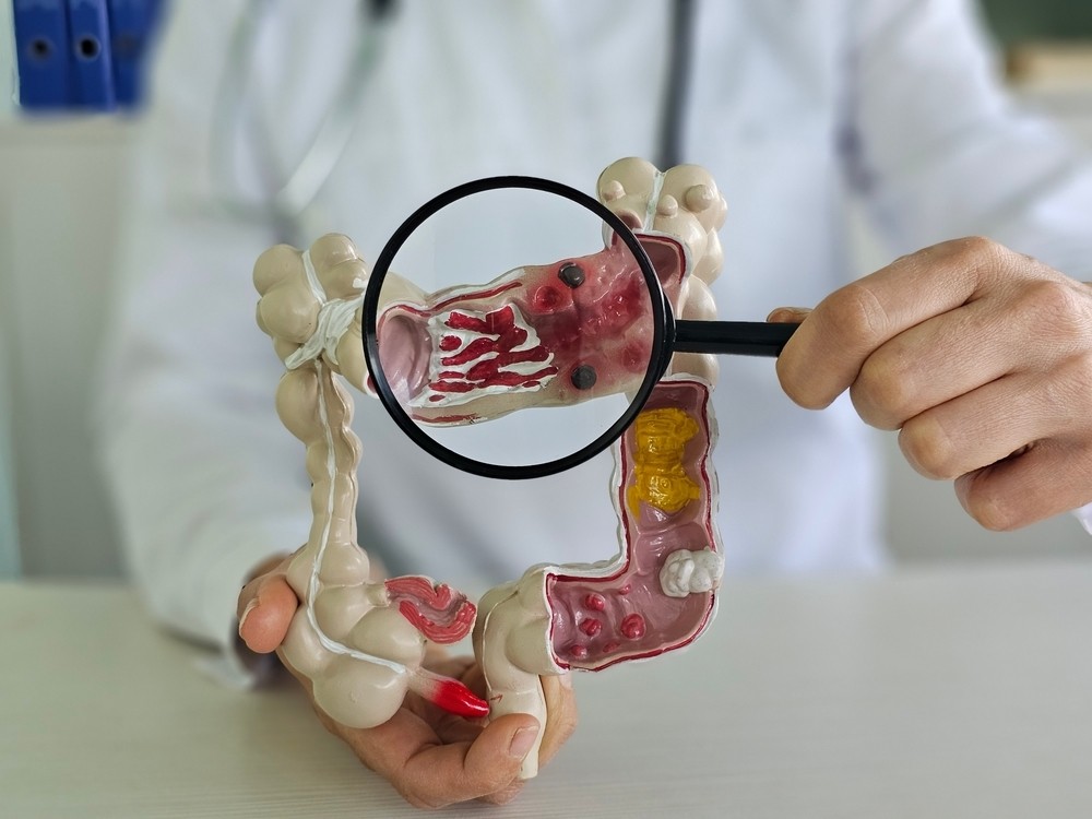 what-is-colon-cancer