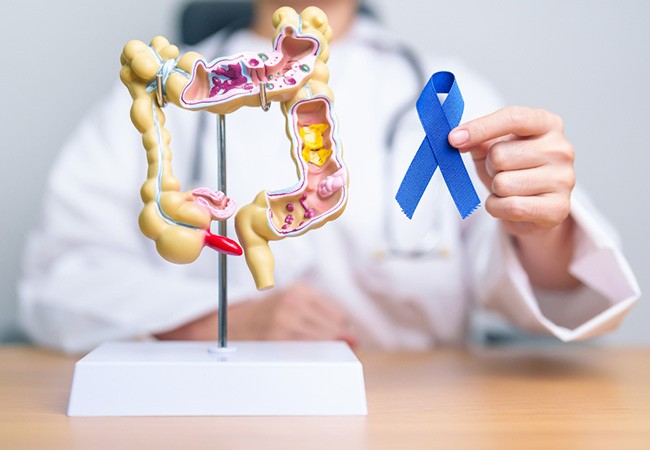 who-is-most-at-risk-for-colon-cancer