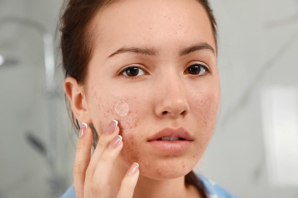 natural-home-remedies-for-acne